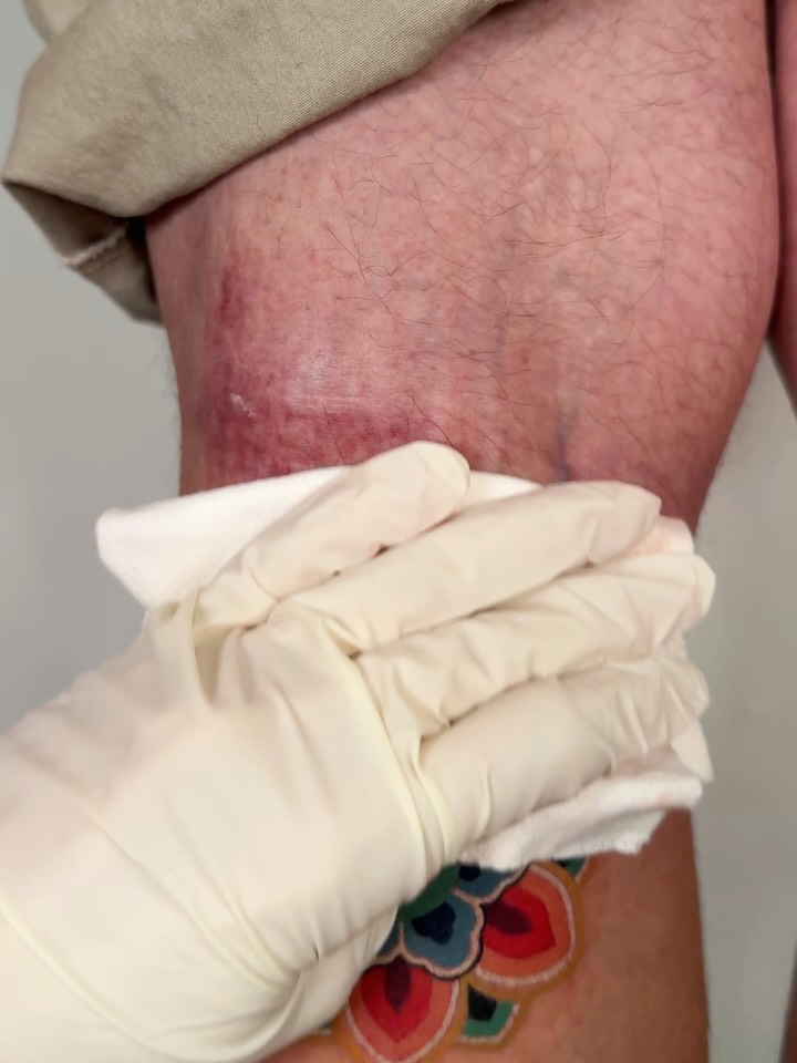 micotattoo